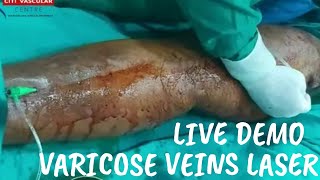 Laser Treatment for Varicose Veins  Varicose veins Laser treatment Live  live EVLT surgery [upl. by Esya]