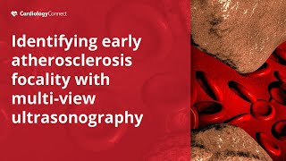 Multiview Carotid Ultrasound in Subclinical Atherosclerosis amp Cardiovascular Risk Factors [upl. by Haonam691]