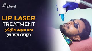 Lip Laser  Spot Remove  Natural Pink Lip  Lips care  Dhaka [upl. by Collum]