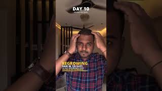 Using Derma roller and Minoxidil for Hair growth  Day 10 minoxidil dermaroller hairloss hair [upl. by Rehpinnej932]