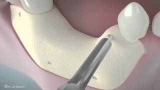 SonicWeld Rx® Dental – Shell technique for vertical defect augmentation [upl. by Nnybor]