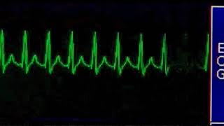 Supraventricular Tachycardia  Taquicardia Supraventricular [upl. by Malachi]