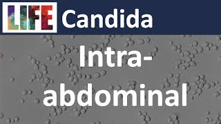 Intraabdominal candidiasis [upl. by Acirema]