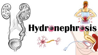 Hydronephrosis  Definition Functional Anatomy Causes Signs amp Symptoms Diagnosis amp Treatment [upl. by Melitta]