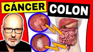 SÍNTOMAS PELIGROSOS de CÁNCER DE COLON RECTO Prevención y Tratamiento [upl. by Delfine542]