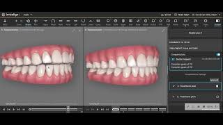 Closing an anterior open bite with Invisalign no attachments no rubber bands or TADs [upl. by Cayser]