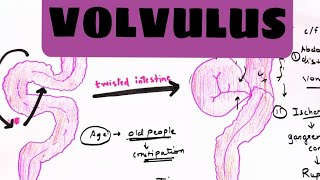 Volvulus  Easy explanation in hindi  5 marks question notes  Definition symptoms investigation [upl. by Aled]