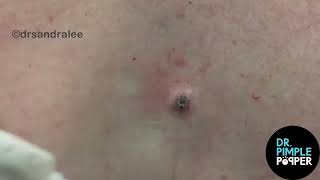 8 Minutes of Satisfying Soft Pops Dr Pimple Popper POPS All Over The Body [upl. by Wyon]