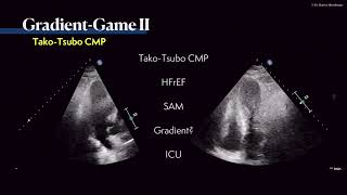 〖Echocardiography〗 Where is the gradient 💘 💫 [upl. by Zeke907]