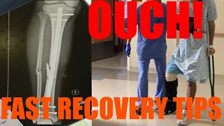 How to Recover Quickly From Broken Leg Fractured Tibia  Fibula ORIF Surgery [upl. by Alecia]