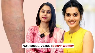 Bollywood Actress taapseepannu Recovered From Varicose Veins with Venaseal Glue Implantation [upl. by Chiang170]