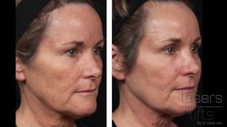 How long does it take to heal from CO2 laser resurfacing Fractional [upl. by Palla]