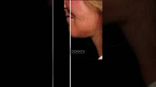 LuxeLift  Lipo  Buccal Fat Reduction  1 month postop cosmeticsurgery plasticsurgery [upl. by Affra]