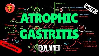 ATROPHIC GASTRITIS Pathogenesis Diagnostic criteria Treatment [upl. by Curnin]