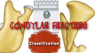 CONDYLAR FRACTURE CLASSIFICATION [upl. by Kumar]