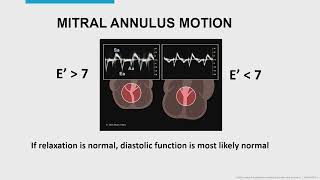 EVALUATION OF DIASTOLIC DYSFUNCTION THE BASICSMAYO CLINIC [upl. by Chrisoula]