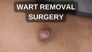 Watch This Wart Removal Surgery Live Procedure  Wart Removal Surgery [upl. by Neevan]