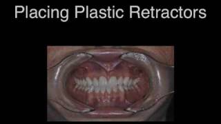 Placing Plastic Dental Retractors [upl. by Lebasy]