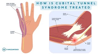 How Is Cubital Tunnel Syndrome Treated  Dr Kyle McClintock [upl. by Tandy]