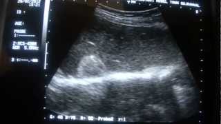 ULTRASOUND LIVER HEMANGIOMAS [upl. by Nnylsaj]