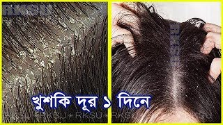 খুশকি মুক্ত চুলের জন্য খুব সহজ ১ টি টিপস। Dandruff Free Hear And Winter Hair Care  Khuski Dur [upl. by Samale]