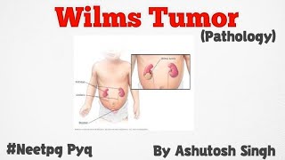 Wilms Tumor For 2nd year University Exams [upl. by Ellicott]