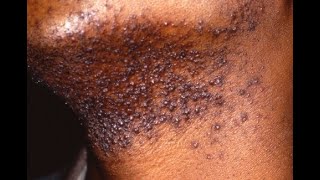 PSEUDOFOLLICULITIS BARBAE Razor Bumps Symptoms Causes Treatment [upl. by Aryan483]