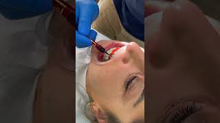 Brighten Your Smile Instantly with Laser Teeth Whitening laserteethwhitening shortvideo [upl. by Weinert]