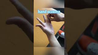 yiganerjing handeczema zudaifu skincare eczema [upl. by Esikram347]