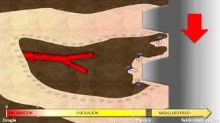 Implantología Oral Biocéntrica Dr Prof Bellotta Resumen OdEspMauricio Haenggi [upl. by Odin]