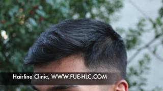 FUE Hair transplant Hairtransplant turkey Hairline lowering [upl. by Auria122]