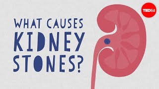 What causes kidney stones  Arash Shadman [upl. by Leffert]