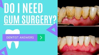 Osseous Surgery  Do I Need Gum Surgery  Why I Need Gum Treatment l Pocket Reduction  Elimination [upl. by Rexfourd]