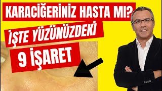 Karaciğer Hastalığının Yüzümüzdeki 9 BELİRTİSİ [upl. by Nareht259]