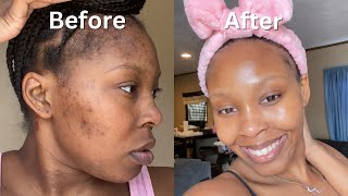 How I Cleared My Acne  Dark Spots  Hyperpigmentation for good in 1 month NO ACCUTANE VIDEO PROOF [upl. by Refynnej]