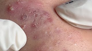 Acne Treatment Huong Da Nang 595  2024 [upl. by Cagle]