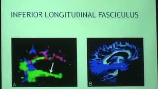 Role of MR DTI amp tractography in neurological diseases [upl. by Lewie]