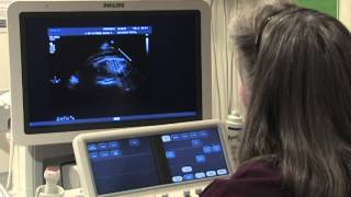 What Is a Fetal Echochardiogram Test [upl. by Jardena443]