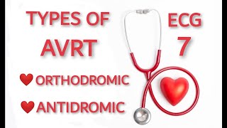 AVRT TYPES ORTHODROMIC AND ANTIDROMIC [upl. by Ahcmis242]