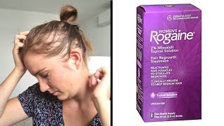 MINOXIDILROGAINE amp ALOPECIA My 10 years treatment experience review [upl. by Deegan]