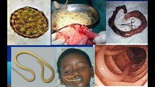 Ascaris Lumbricoides Ascariasis Morphology  Life cycle  Pathogesis  Treatment  Parasitology [upl. by Kippie]