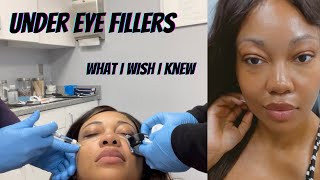 What I wish I knew before getting Under Eye filler [upl. by Mozza637]