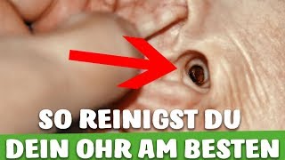 SO reinigst DU dein OHR richtig  OHRENSCHMALZ SICHER ENTFERNEN [upl. by Atihcnoc]