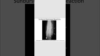 Sunburst periosteal reactionosteosarcoma radiology orthopedics [upl. by Quiteris]