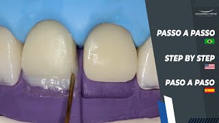 Diastema and Incisal Increase I Diastema y Alargamiento Incisal I Diastema e Aumento Incisal [upl. by Nevanod437]