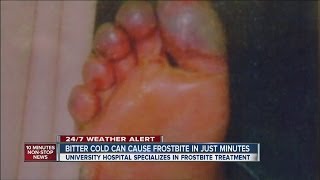 Bitter cold can cause frostbite in just minutes [upl. by Gayelord283]