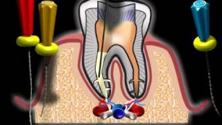 Complicazioni di canale radicolare [upl. by Alekram]