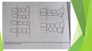 Orthodontics  Cast Analysis  Part 3 ALD  Mixed Dentition Analysis  Bolton Analysis [upl. by Aehcim931]