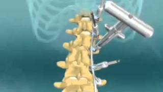 Scoliosis Spinal Fusion Animation [upl. by Adyaj]