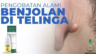 Bagaimana Cara Menyembuhkan Benjolan di Telinga Berikut Beragam Cara Pengobatannya [upl. by Letsyrc64]